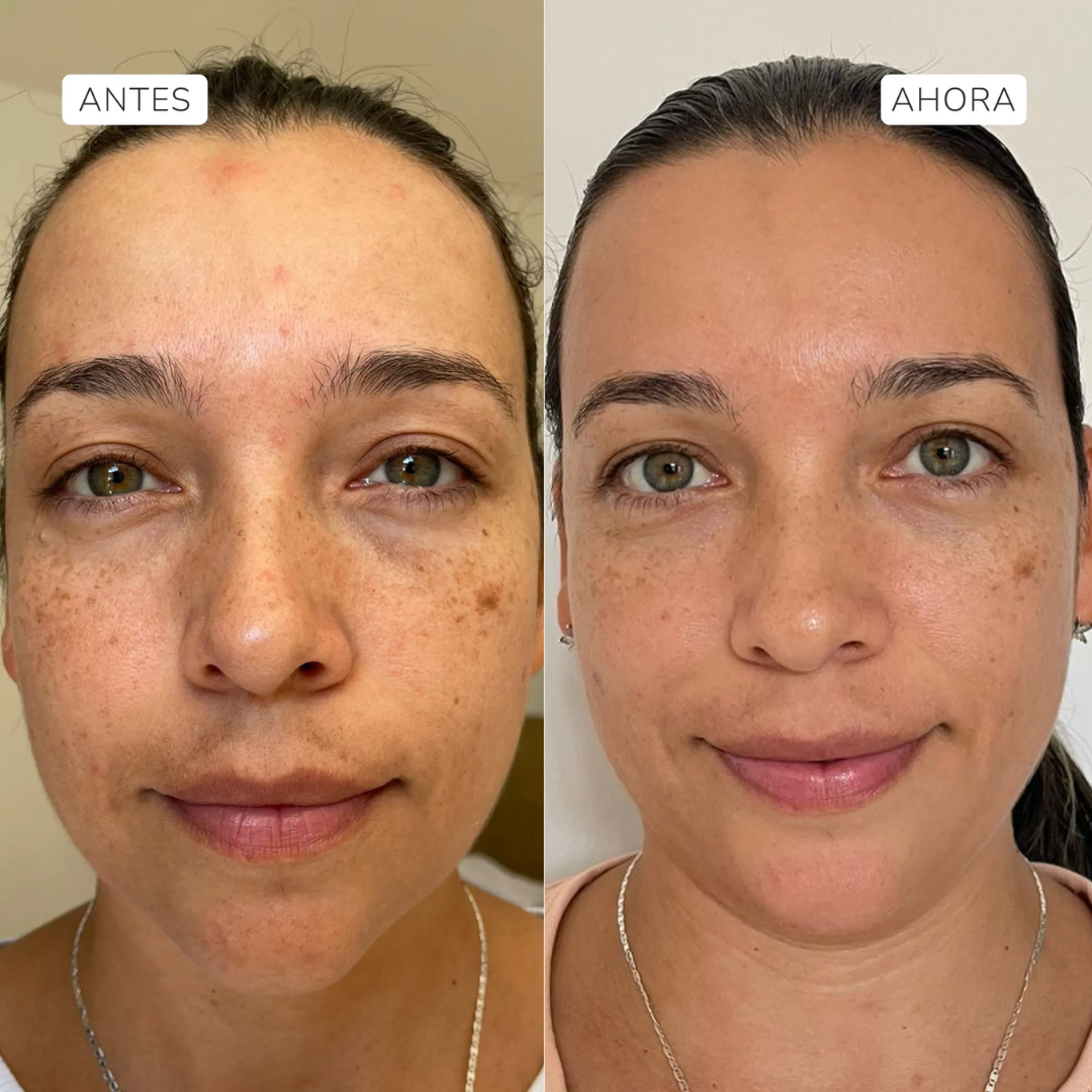 resueltos antes y depues de usar el Suero facial Fito Retinol de Aruná.